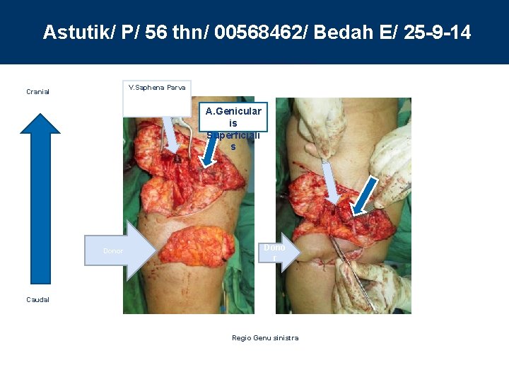 Astutik/ P/ 56 thn/ 00568462/ Bedah E/ 25 -9 -14 Anastomose Arteri & Vena