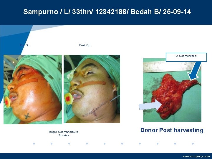 Sampurno / L/ 33 thn/ 12342188/ Bedah B/ 25 -09 -14 Pre Op Post