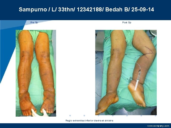 Sampurno / L/ 33 thn/ 12342188/ Bedah B/ 25 -09 -14 Pre Op Post