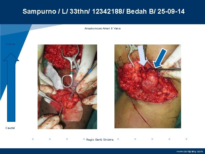 Sampurno / L/ 33 thn/ 12342188/ Bedah B/ 25 -09 -14 Anastomose Arteri &