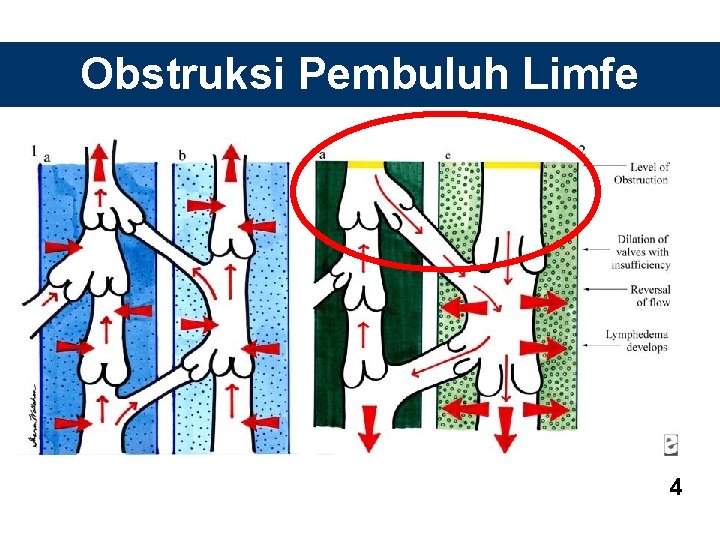Obstruksi Pembuluh Limfe 4 