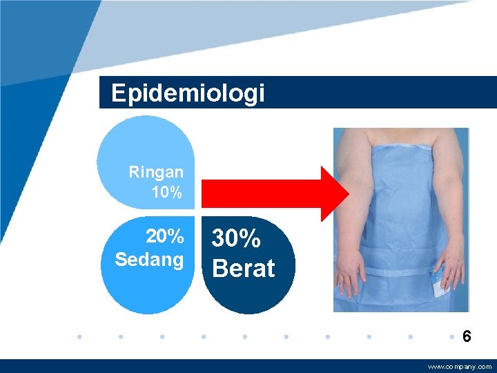 Epidemiologi Ringan 10% 20% Sedang 30% Berat 6 www. company. com 