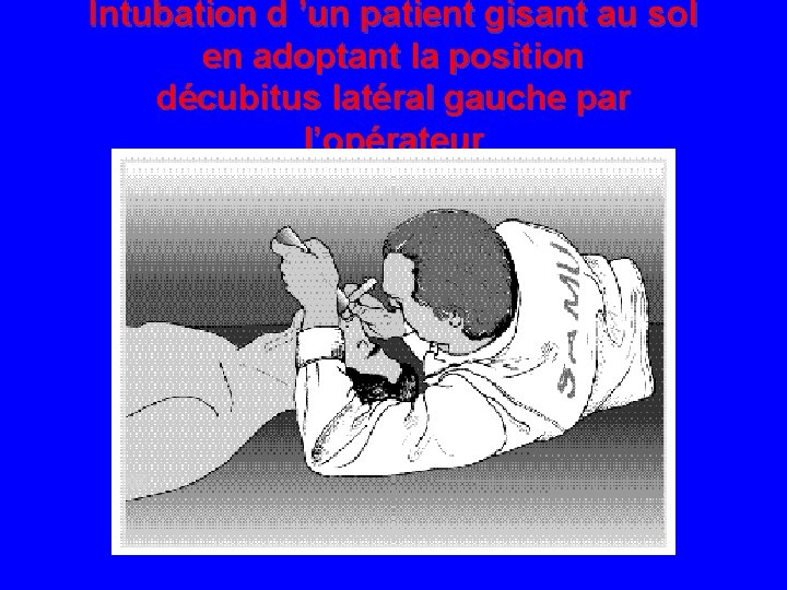 Intubation d ’un patient gisant au sol en adoptant la position décubitus latéral gauche