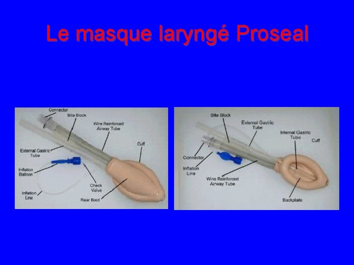 Le masque laryngé Proseal 