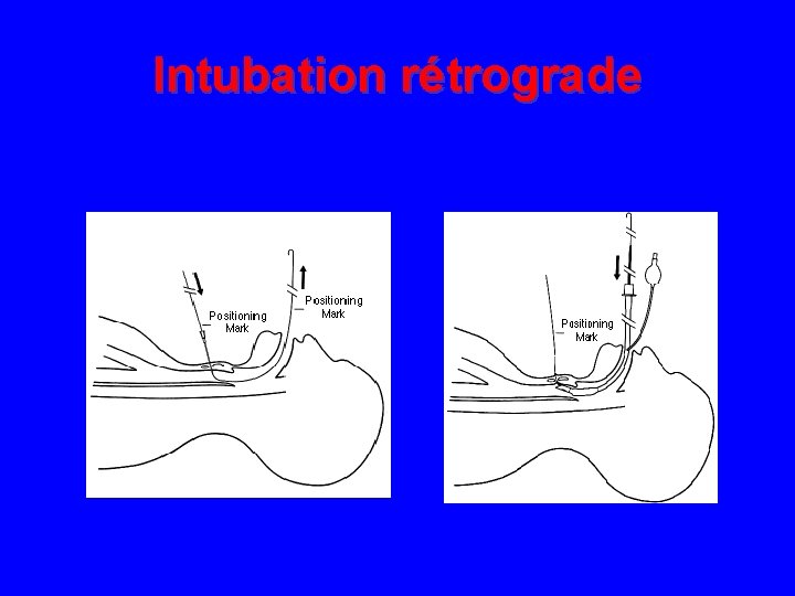 Intubation rétrograde 