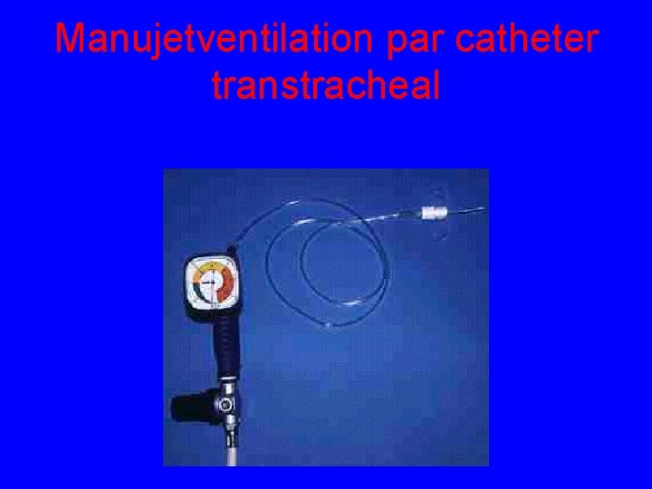 Manujetventilation par catheter transtracheal 