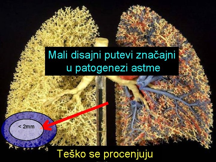 Mali disajni putevi značajni u patogenezi astme < 2 mm Teško se procenjuju 