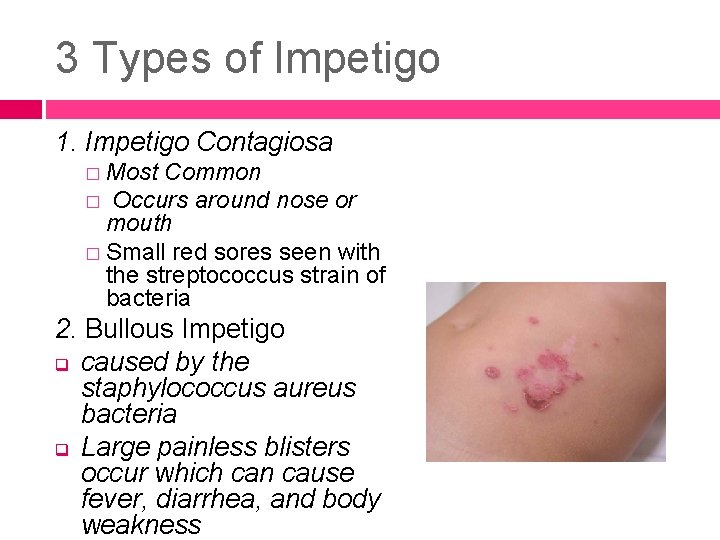 3 Types of Impetigo 1. Impetigo Contagiosa � Most Common � Occurs around nose