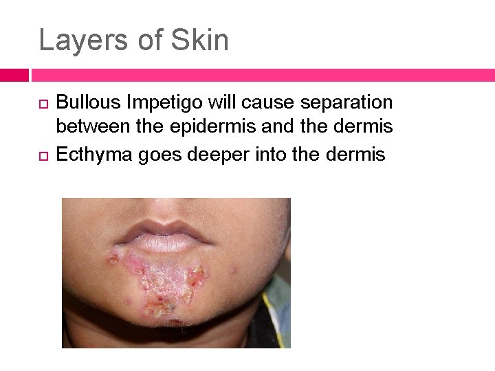 Layers of Skin Bullous Impetigo will cause separation between the epidermis and the dermis