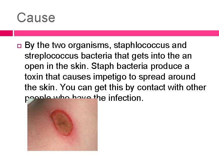 Cause By the two organisms, staphlococcus and streplococcus bacteria that gets into the an