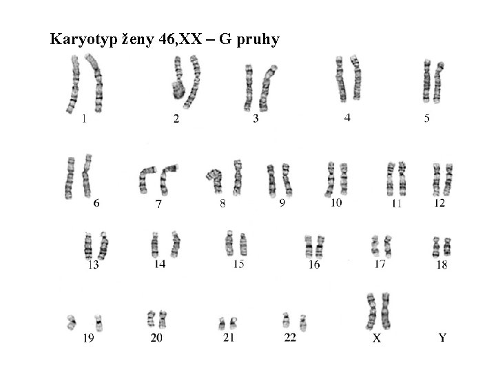 Karyotyp ženy 46, XX – G pruhy 