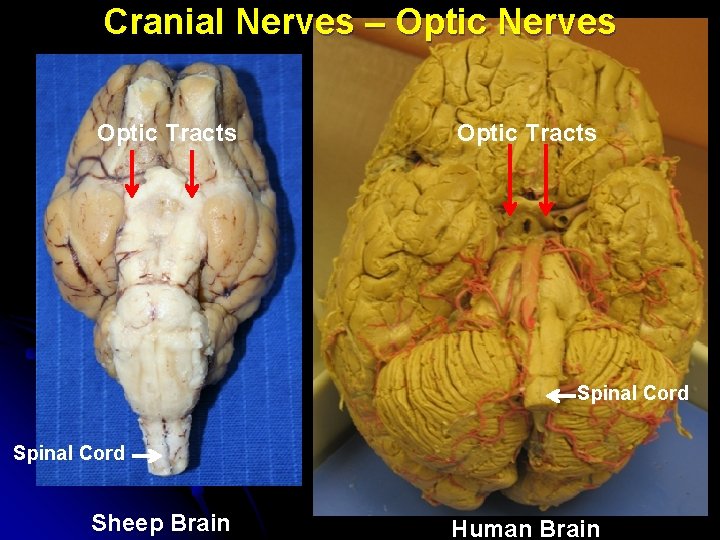 Cranial Nerves – Optic Nerves Optic Tracts Spinal Cord Sheep Brain Human Brain 