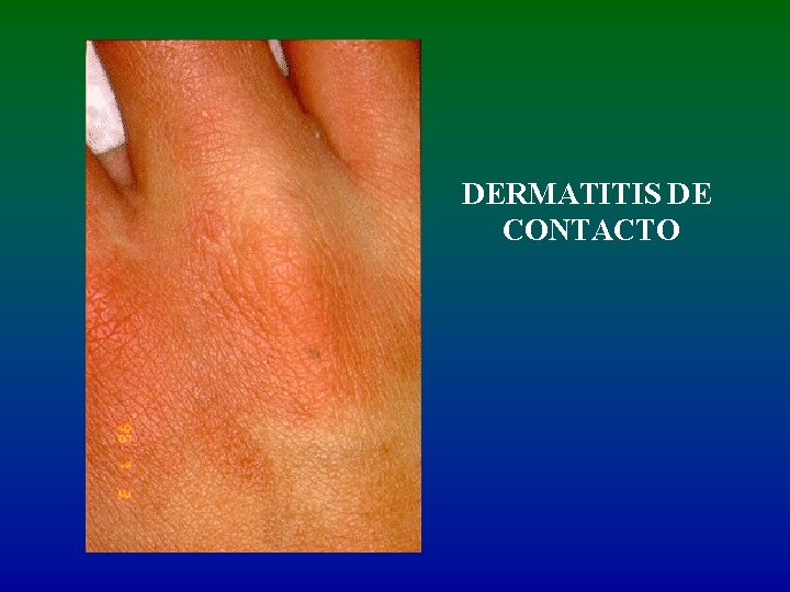 DERMATITIS DE CONTACTO 