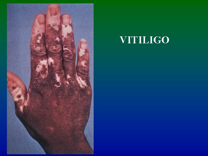 VITILIGO 