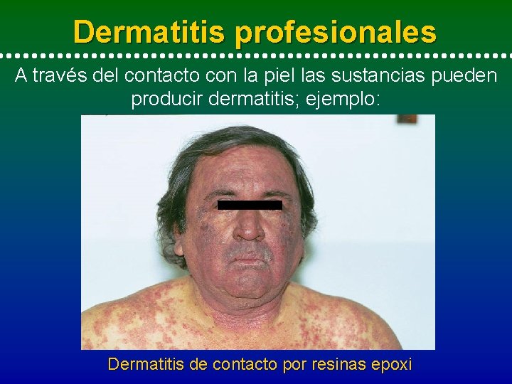 Dermatitis profesionales A través del contacto con la piel las sustancias pueden producir dermatitis;