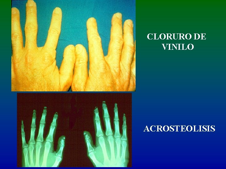 CLORURO DE VINILO ACROSTEOLISIS 