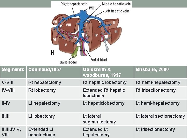 Segments Couinaud, 1957 Goldsmith & woodburne, 1957 Brisbane, 2000 V-VIII Rt hepatectomy Rt hepatic