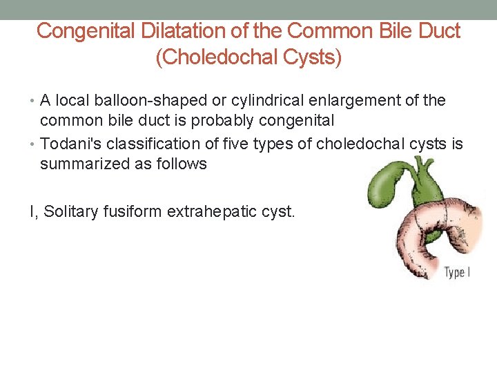 Congenital Dilatation of the Common Bile Duct (Choledochal Cysts) • A local balloon-shaped or