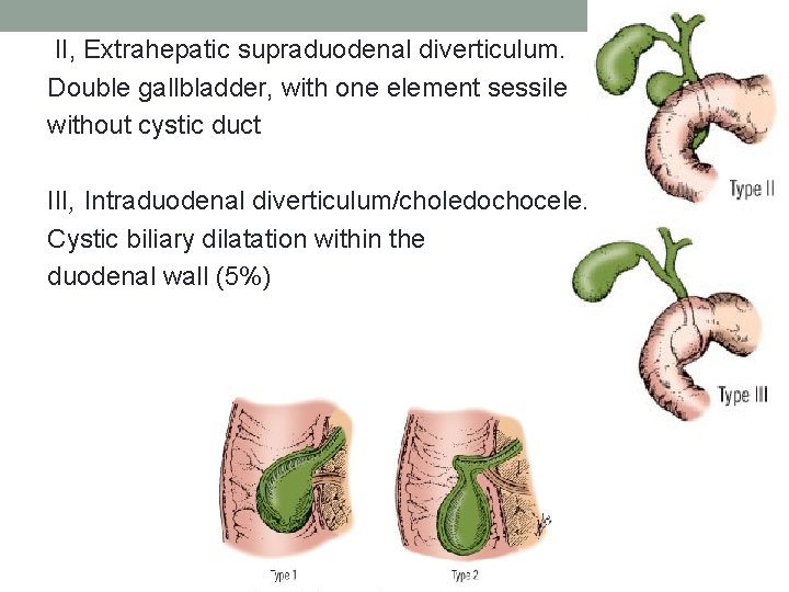 II, Extrahepatic supraduodenal diverticulum. Double gallbladder, with one element sessile without cystic duct III,