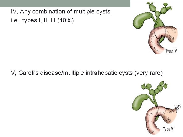 IV, Any combination of multiple cysts, i. e. , types I, III (10%) V, IV, Any combination of multiple cysts, i. e. , types I, III (10%) V,