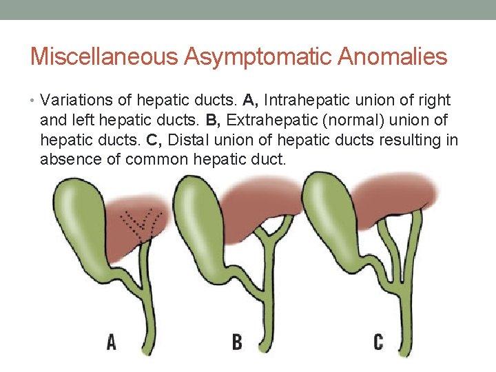 Miscellaneous Asymptomatic Anomalies • Variations of hepatic ducts. A, Intrahepatic union of right and