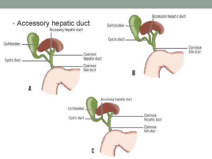 • Accessory hepatic duct • Accessory hepatic duct