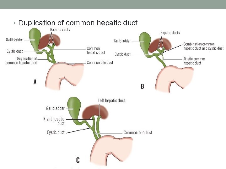  • Duplication of common hepatic duct 