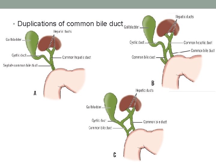  • Duplications of common bile duct 