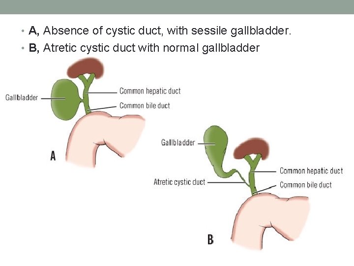 • A, Absence of cystic duct, with sessile gallbladder. • B, Atretic cystic • A, Absence of cystic duct, with sessile gallbladder. • B, Atretic cystic