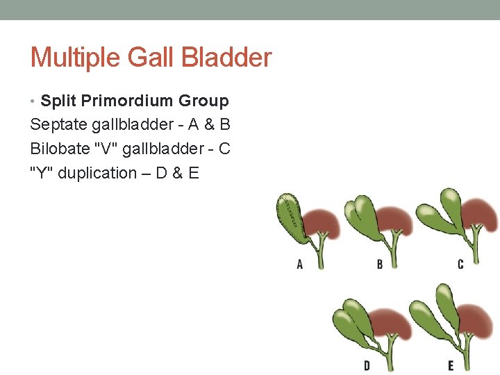 Multiple Gall Bladder • Split Primordium Group Septate gallbladder - A & B Bilobate