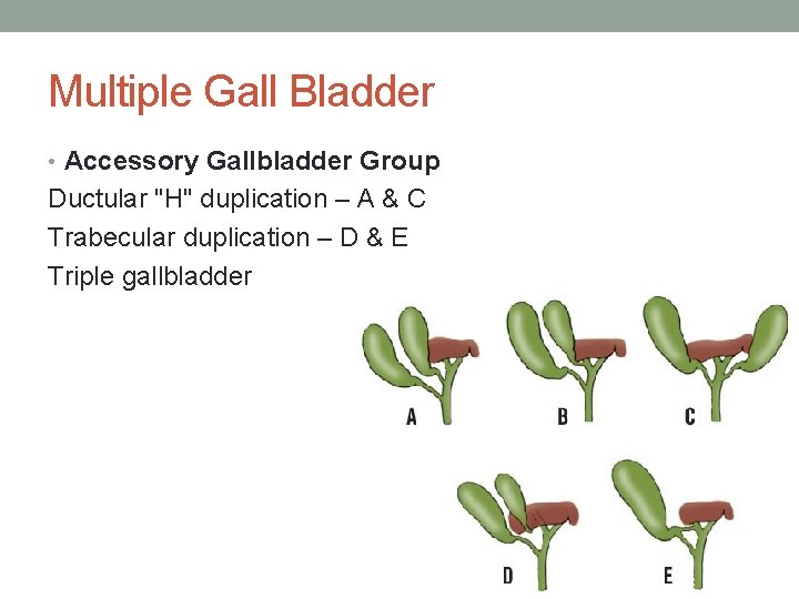 Multiple Gall Bladder • Accessory Gallbladder Group Ductular "H" duplication – A & C Multiple Gall Bladder • Accessory Gallbladder Group Ductular "H" duplication – A & C