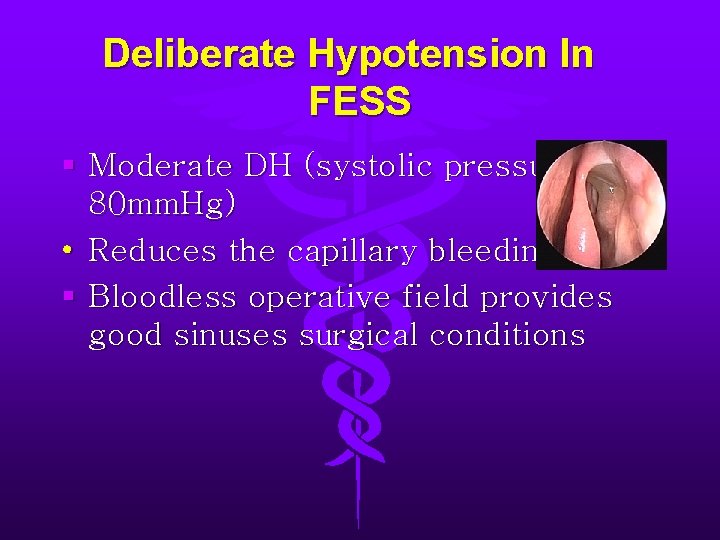 Deliberate Hypotension In FESS § Moderate DH (systolic pressure 80 80 mm. Hg) •