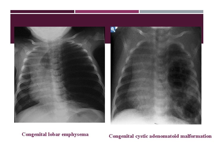Congenital lobar emphysema Congenital cystic adenomatoid malformation 