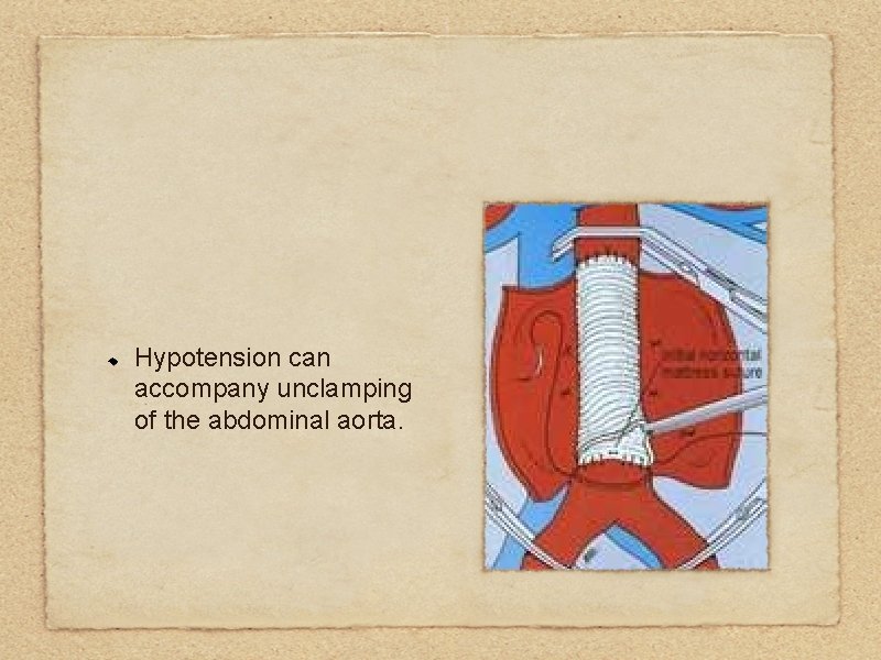 Hypotension can accompany unclamping of the abdominal aorta. 