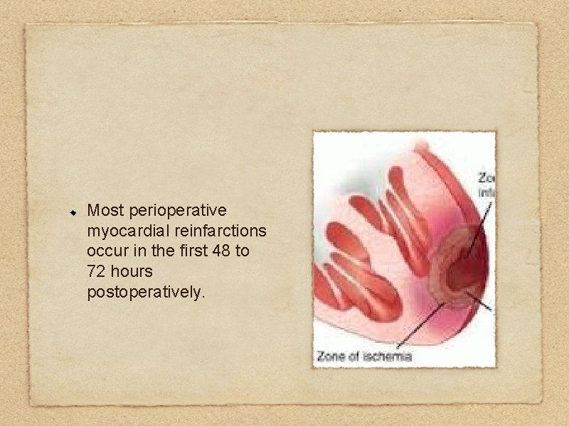 Most perioperative myocardial reinfarctions occur in the first 48 to 72 hours postoperatively. 