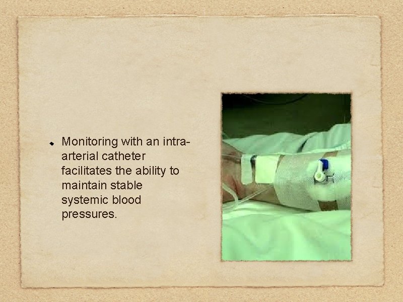 Monitoring with an intraarterial catheter facilitates the ability to maintain stable systemic blood pressures.