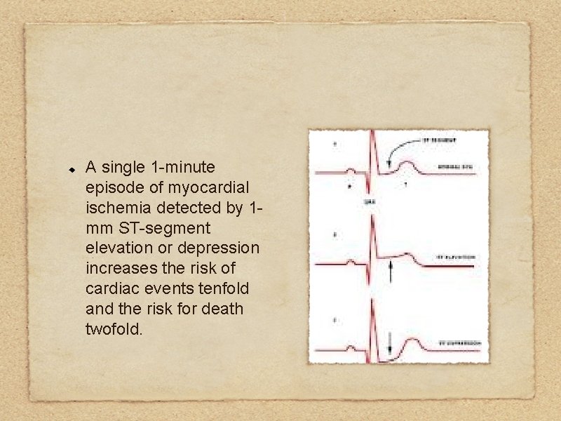 A single 1 -minute episode of myocardial ischemia detected by 1 mm ST-segment elevation