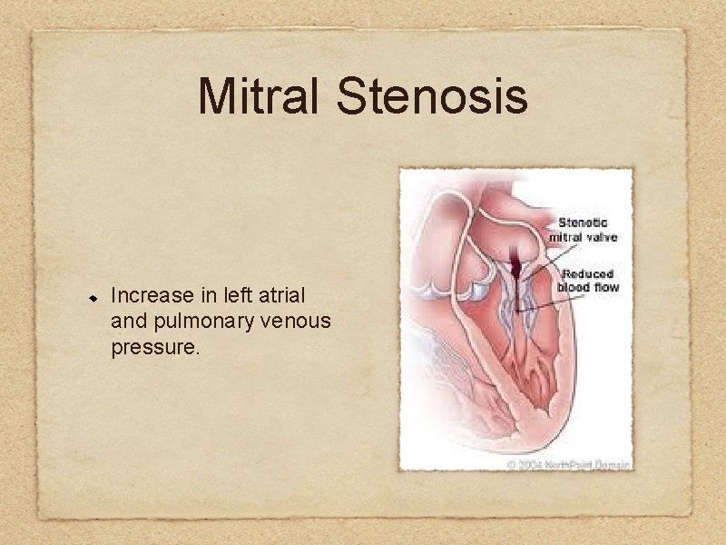 Mitral Stenosis Increase in left atrial and pulmonary venous pressure. 