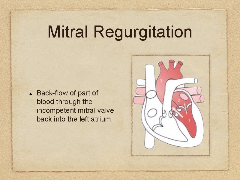 Mitral Regurgitation Back-flow of part of blood through the incompetent mitral valve back into