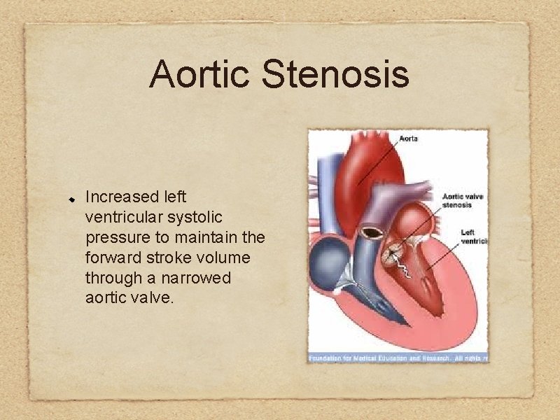 Aortic Stenosis Increased left ventricular systolic pressure to maintain the forward stroke volume through