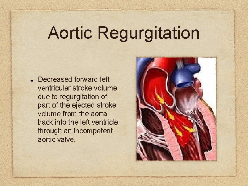 Aortic Regurgitation Decreased forward left ventricular stroke volume due to regurgitation of part of