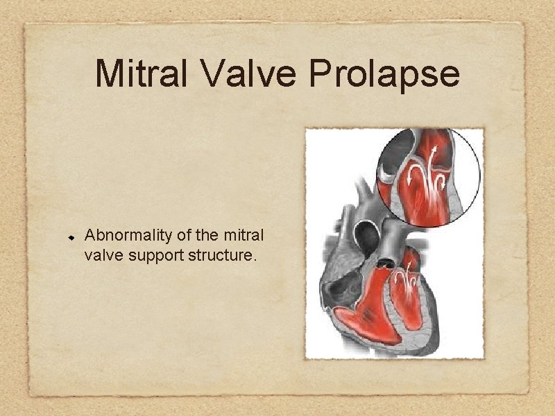 Mitral Valve Prolapse Abnormality of the mitral valve support structure. 