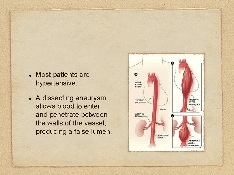 Most patients are hypertensive. A dissecting aneurysm: allows blood to enter and penetrate between