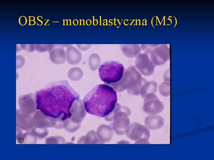 OBSz – monoblastyczna (M 5) 