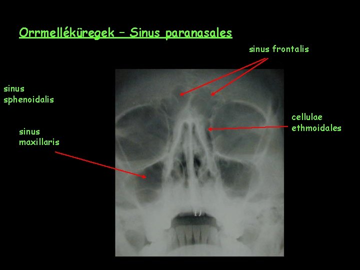 Orrmelléküregek – Sinus paranasales sinus frontalis sinus sphenoidalis sinus maxillaris cellulae ethmoidales 