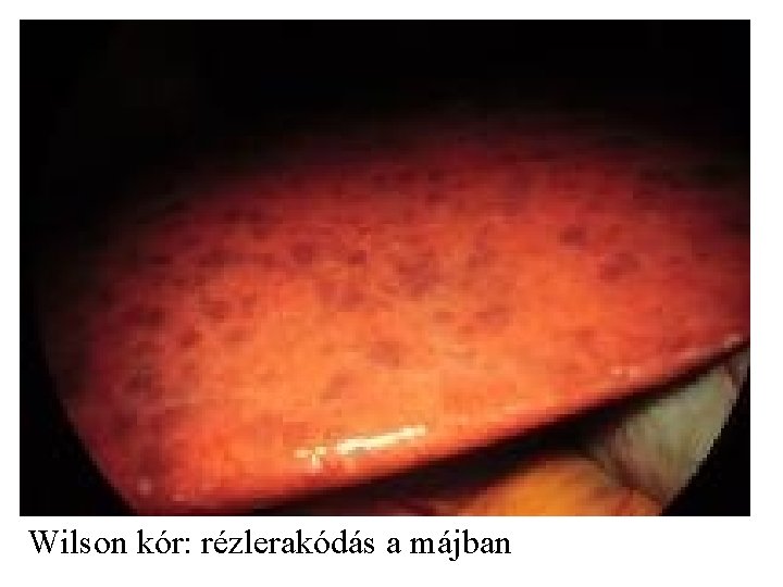 Wilson kór: rézlerakódás a májban 