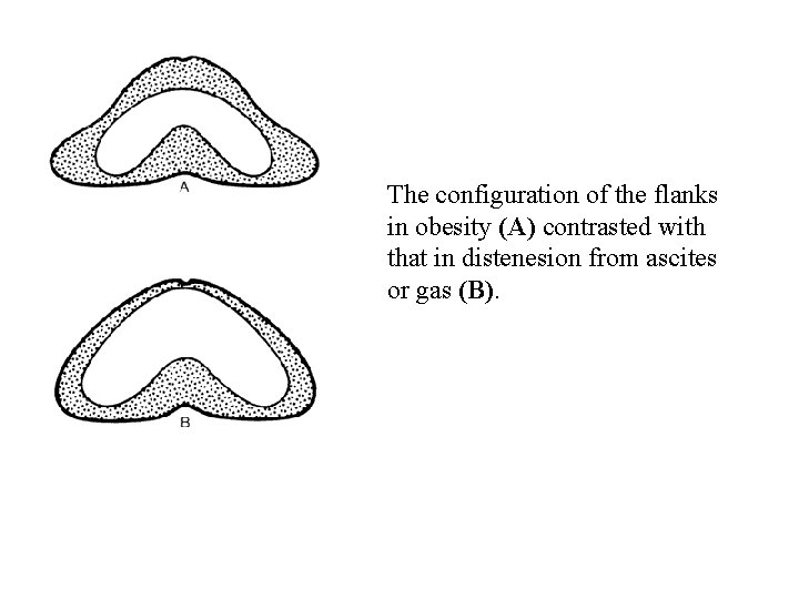 The configuration of the flanks in obesity (A) contrasted with that in distenesion from