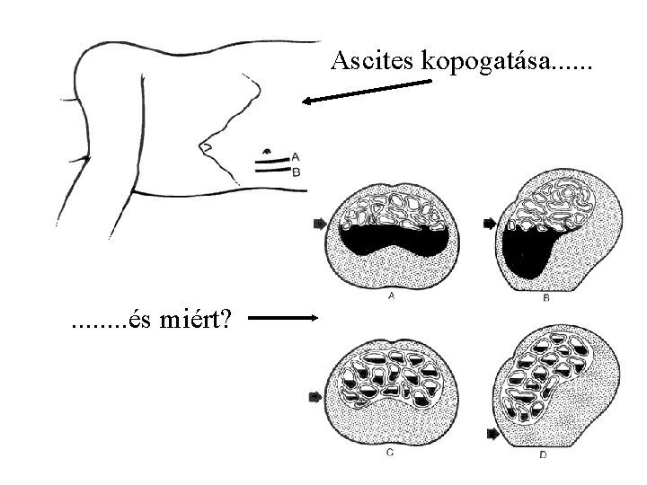 Ascites kopogatása. . . és miért? 