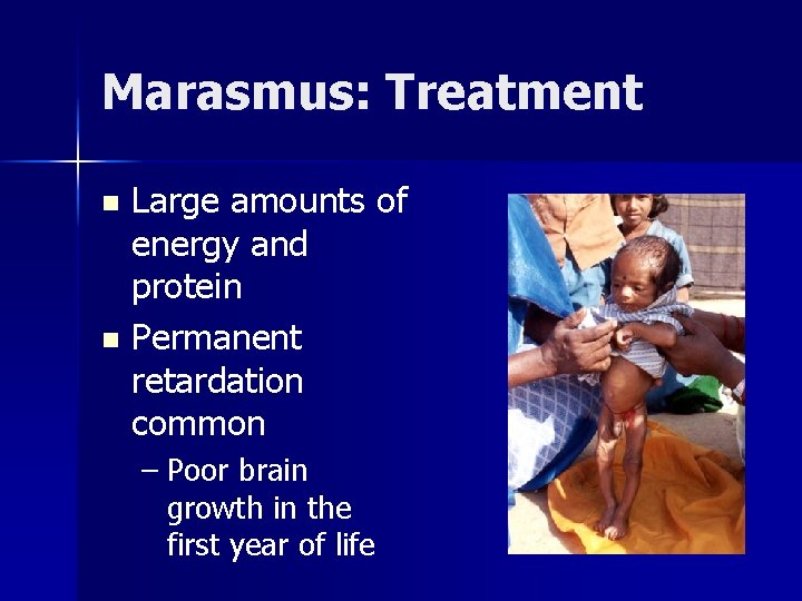 Marasmus: Treatment Large amounts of energy and protein n Permanent retardation common n –