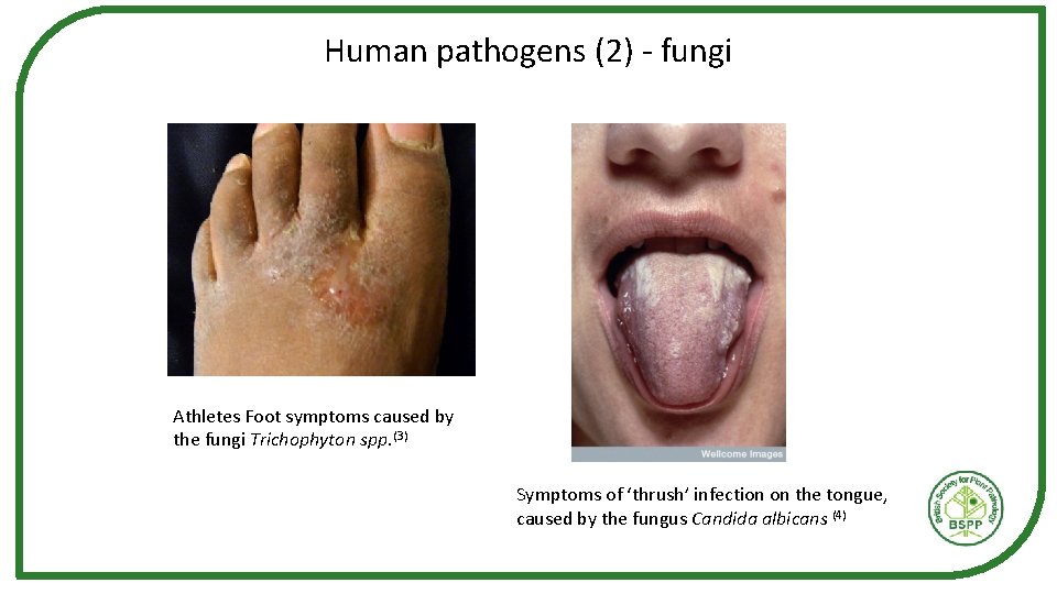 Human pathogens (2) - fungi Athletes Foot symptoms caused by the fungi Trichophyton spp.